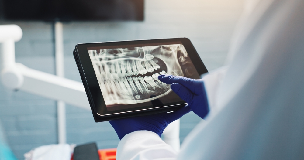 Dental Model Demonstrating Tooth Implant – Dental Implants