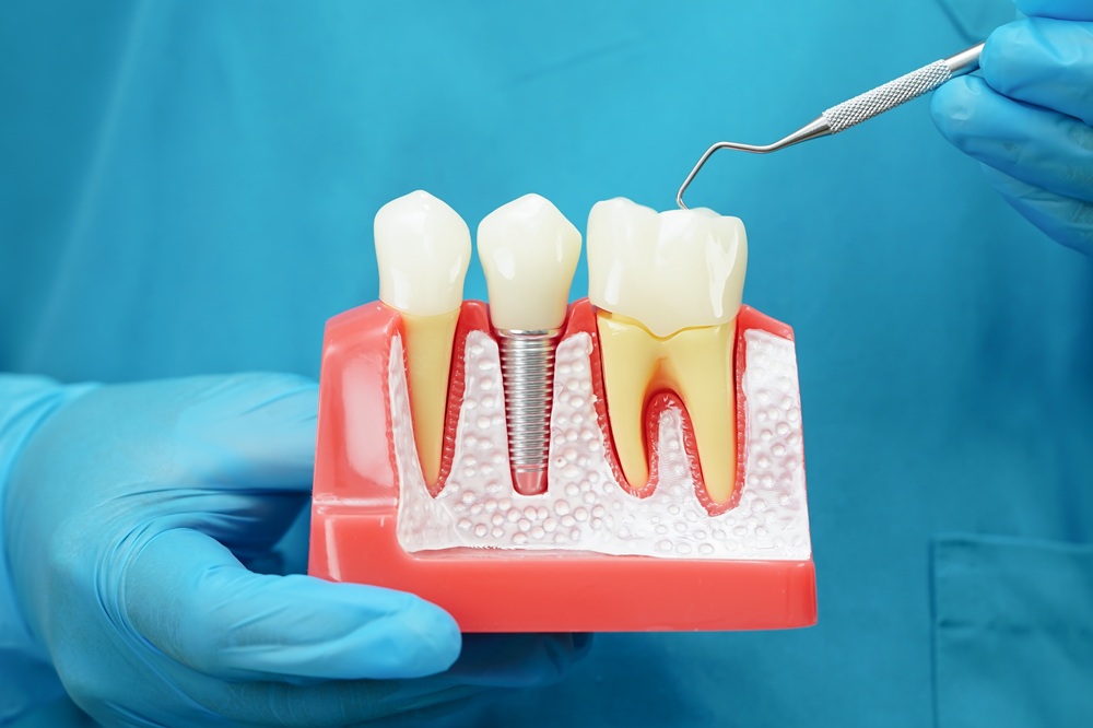 Dental Model Demonstrating Tooth Implant – Dental Implants A close-up of a dental model held by gloved hands, showing a dental implant placed between two natural teeth, with a metal tool pointing at the gum line – Dental Implants